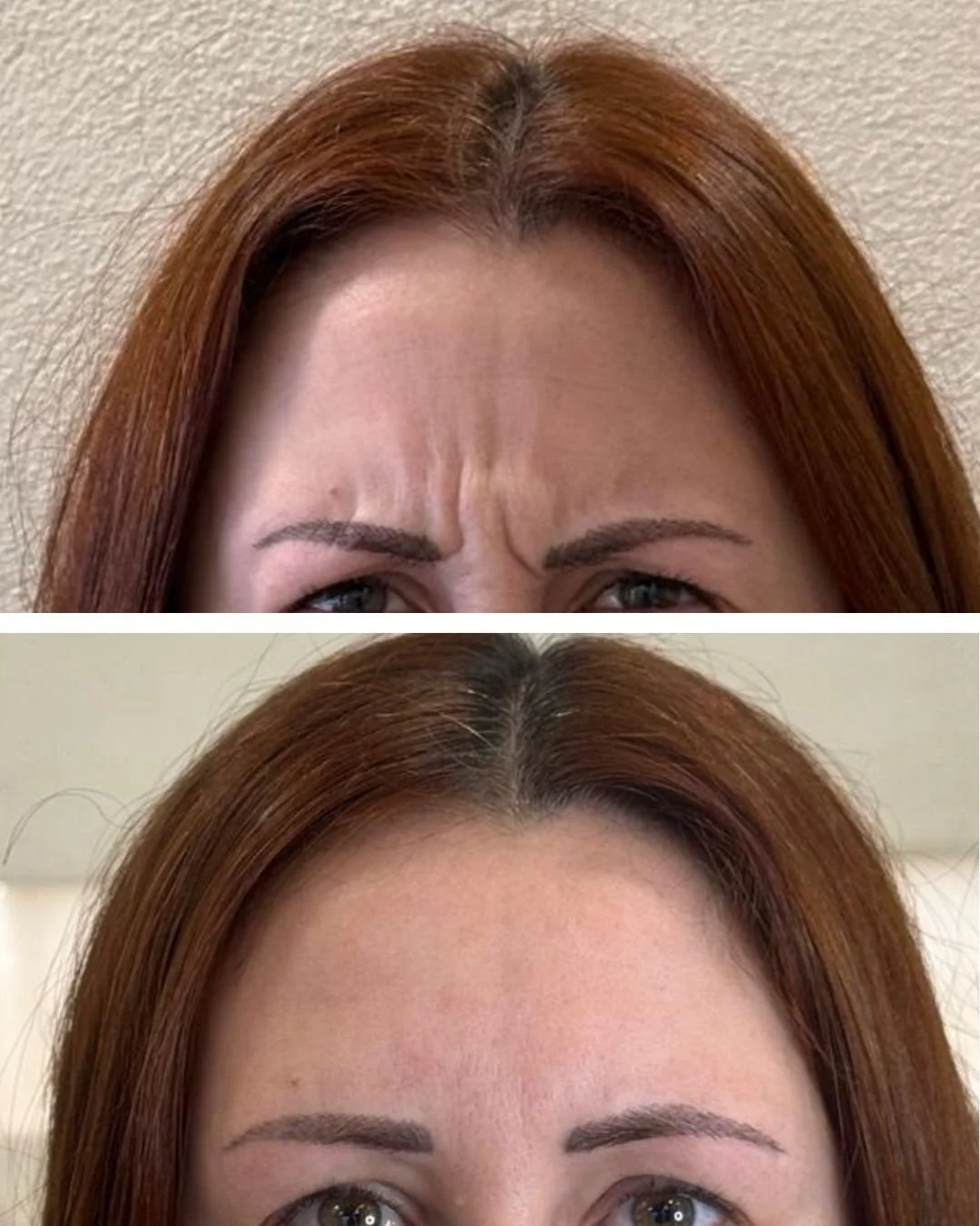 Fotografía con dos imágenes que muestran la frente de una mujer con el cabello rojo, la primera con ceños fruncidos y la segunda con expresión relajada.