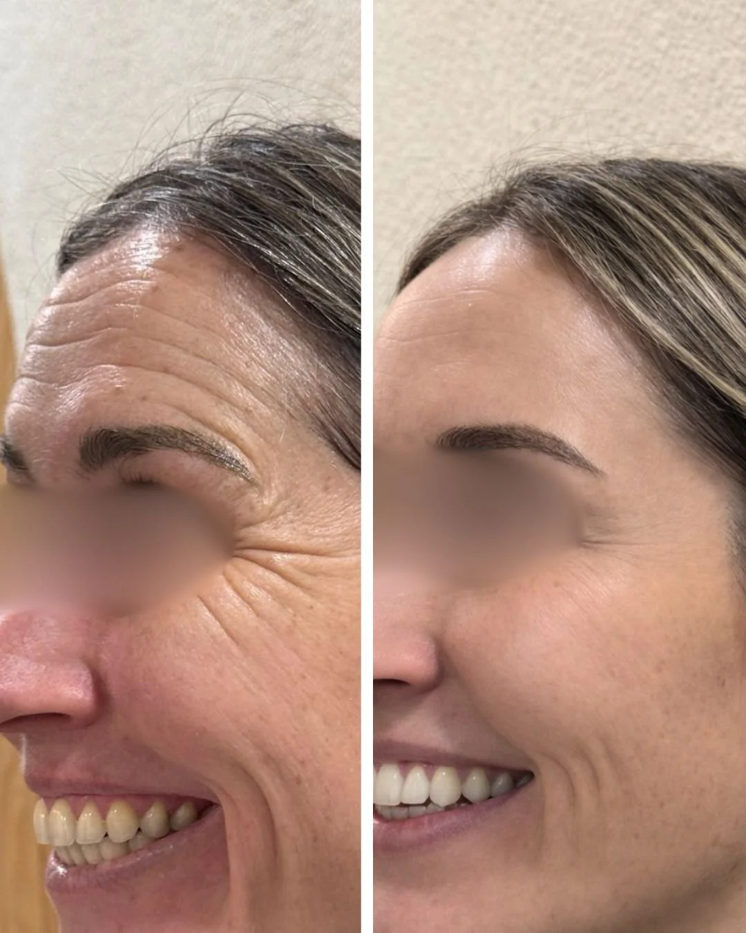 Comparación de antes y después de tratamiento de arrugas y líneas de expresión en la cara de una mujer, mostrando una mejora significativa en la piel.