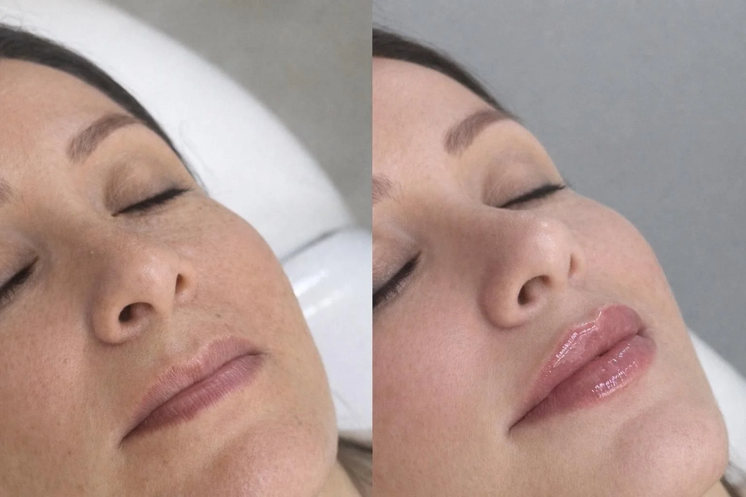 Comparación antes y después de un tratamiento de belleza facial en una mujer con la piel clara, mostrando mejoras en la apariencia del rostro y los labios.