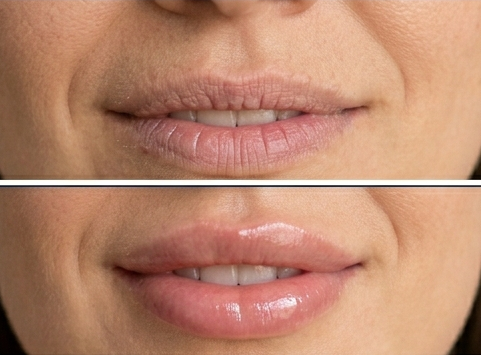 Primer plano de labios, antes y después del uso de un producto que mejora su apariencia, mostrando una textura más suave y un brillo saludable en la segunda imagen.
