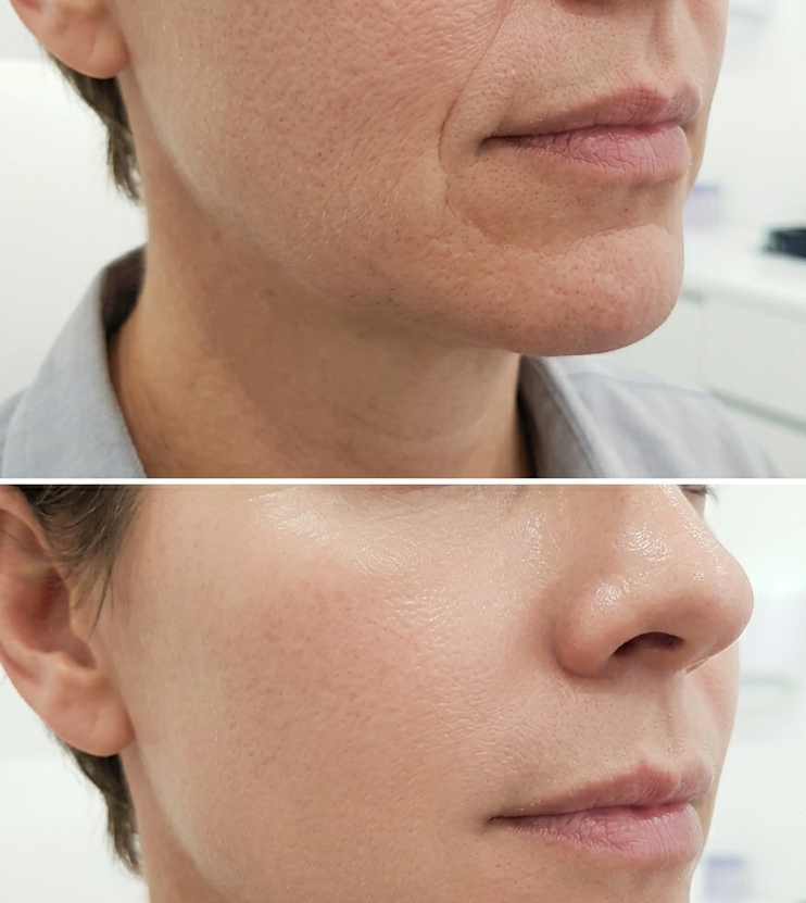 Comparación antes y después de un tratamiento facial, mostrando piel con poros dilatados en la parte superior y piel más lisa y uniforme en la parte inferior.