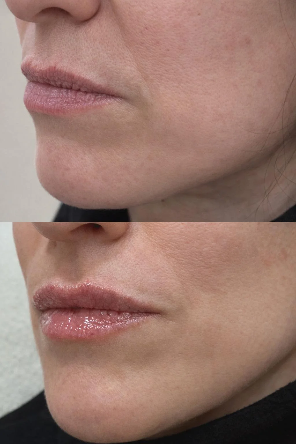 Comparación de labios secos y labios hidratados, mostrando mejora después del cuidado.