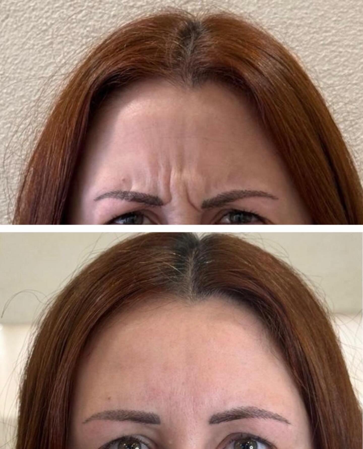 Els neuromoduladors s&oacute;n un tractament de medicina est&egrave;tica que ajuda a relaxar la musculatura facial responsable de les arrugues d&rsquo;expressi&oacute;, aconseguint una mirada m&eacute;s descansada, un rostre m&eacute;s fresc i un res