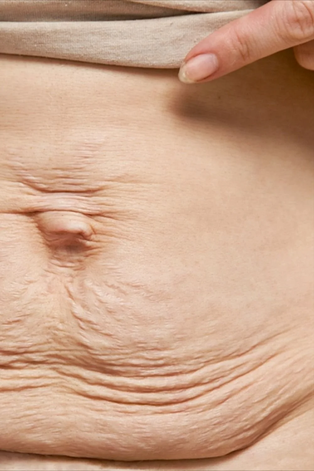 Piel de abdomen con arrugas y un ombligo visible, con una mano tocando justo arriba del ombligo.