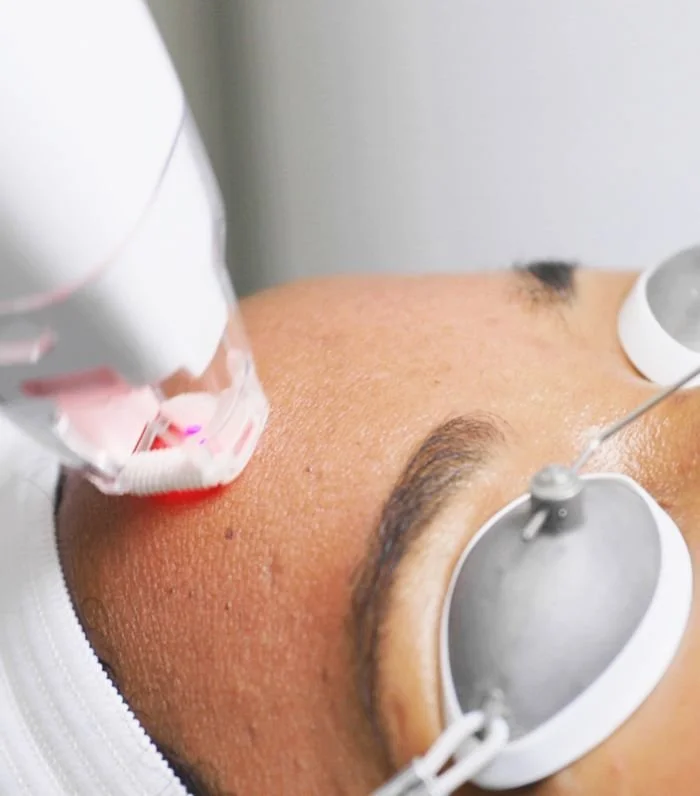 Procedimiento dermatológico con un láser en la frente de una mujer