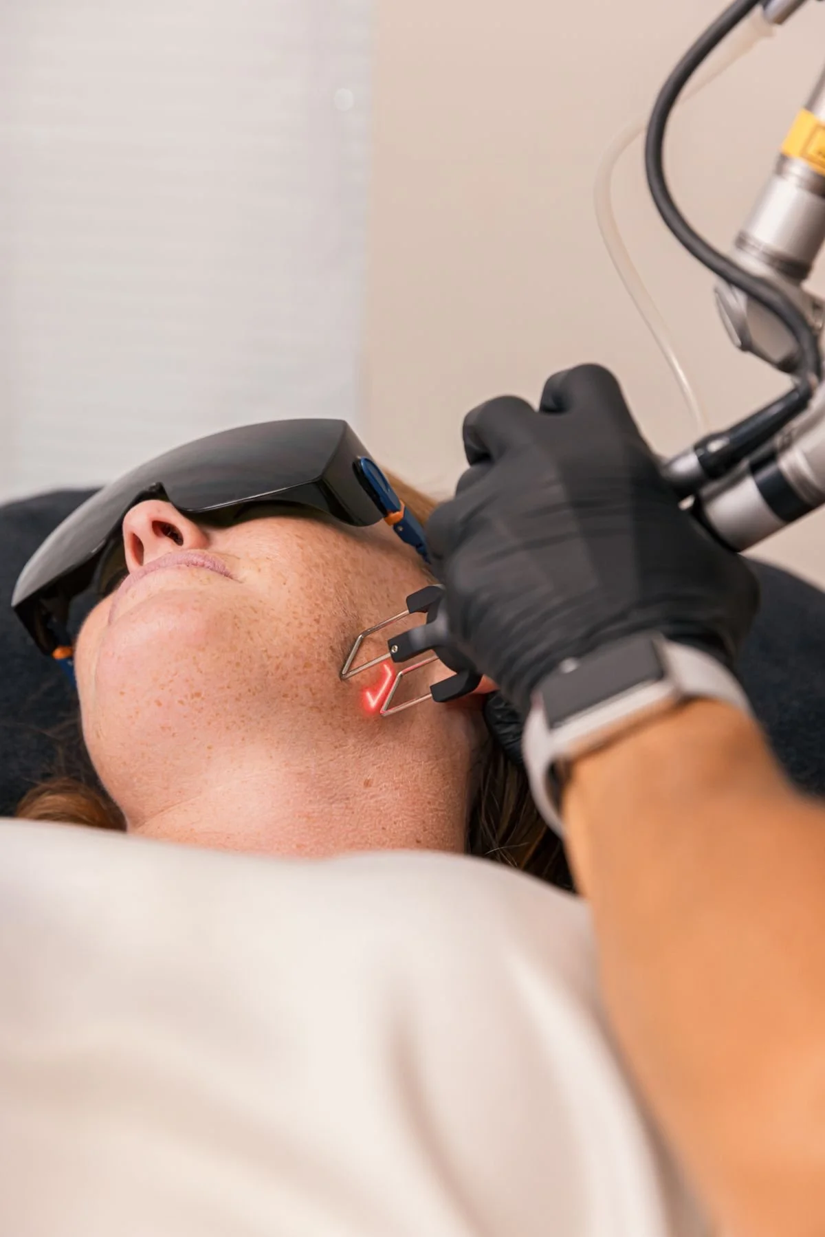Paciente recibiendo tratamiento dermatológico con láser en la cara, con protección ocular y usando guantes.