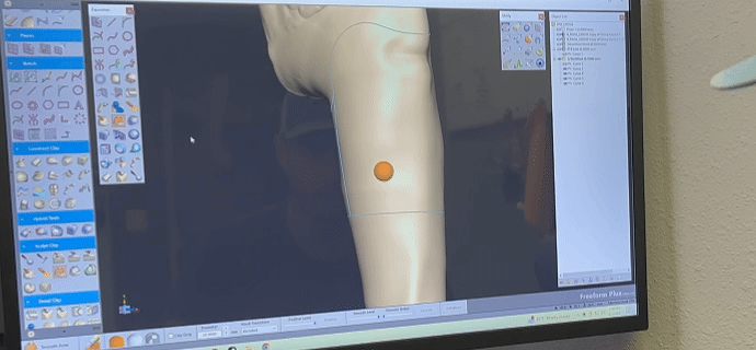 Prosthetic socket fit being engineered in 3D software to support custom design, alignment, and fabrication.