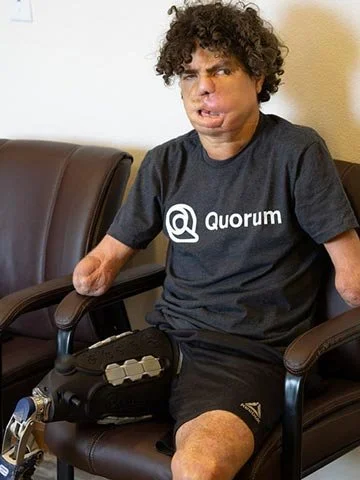 One Leg At A Time recipient showing his Quatro Adjustable Socket, representing the nonprofit’s support for mobility and prosthetic care.
