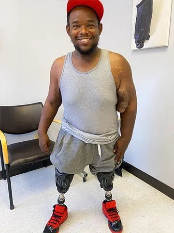 One Leg At A Time recipient who is a bilateral amputee shown with two Quatro Adjustable Sockets.