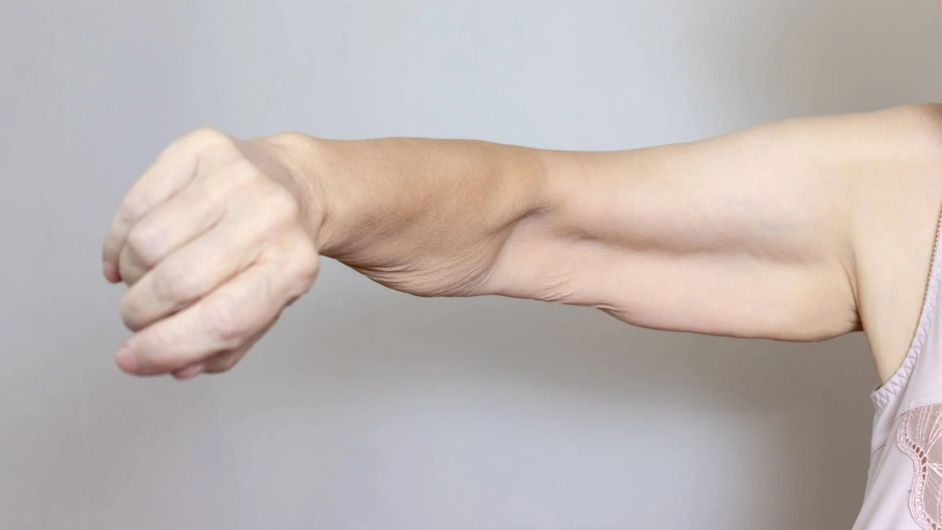 woman showing off loose arm skin