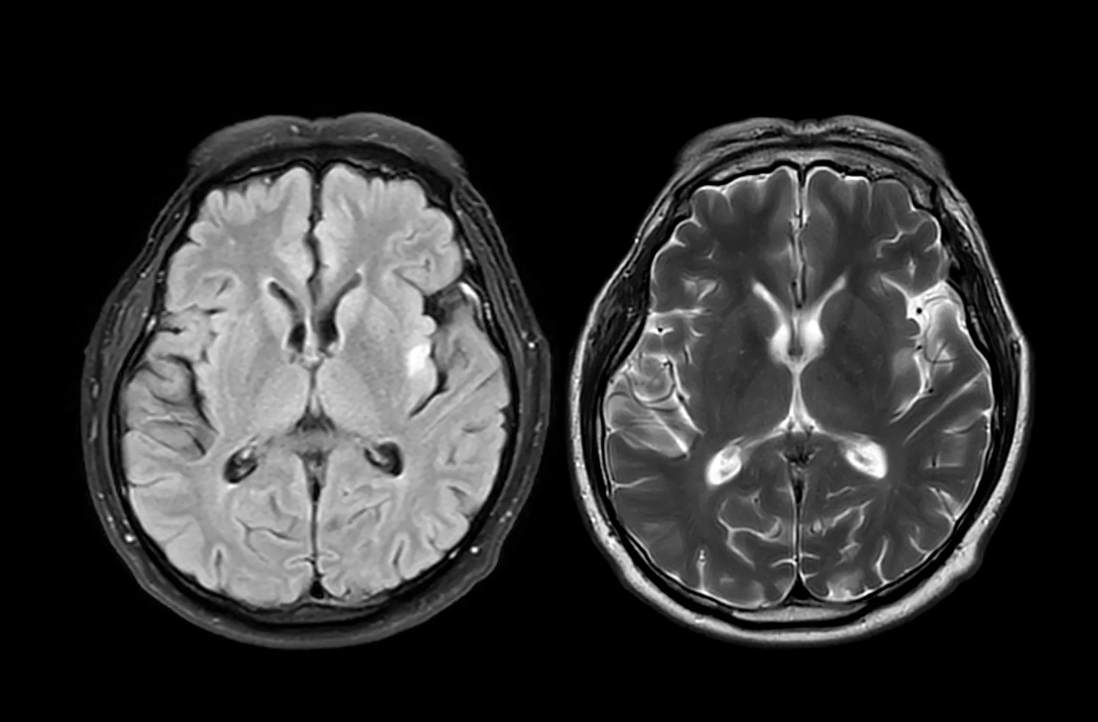 MRI scan of two cross-sectional views of a human brain on a black background.