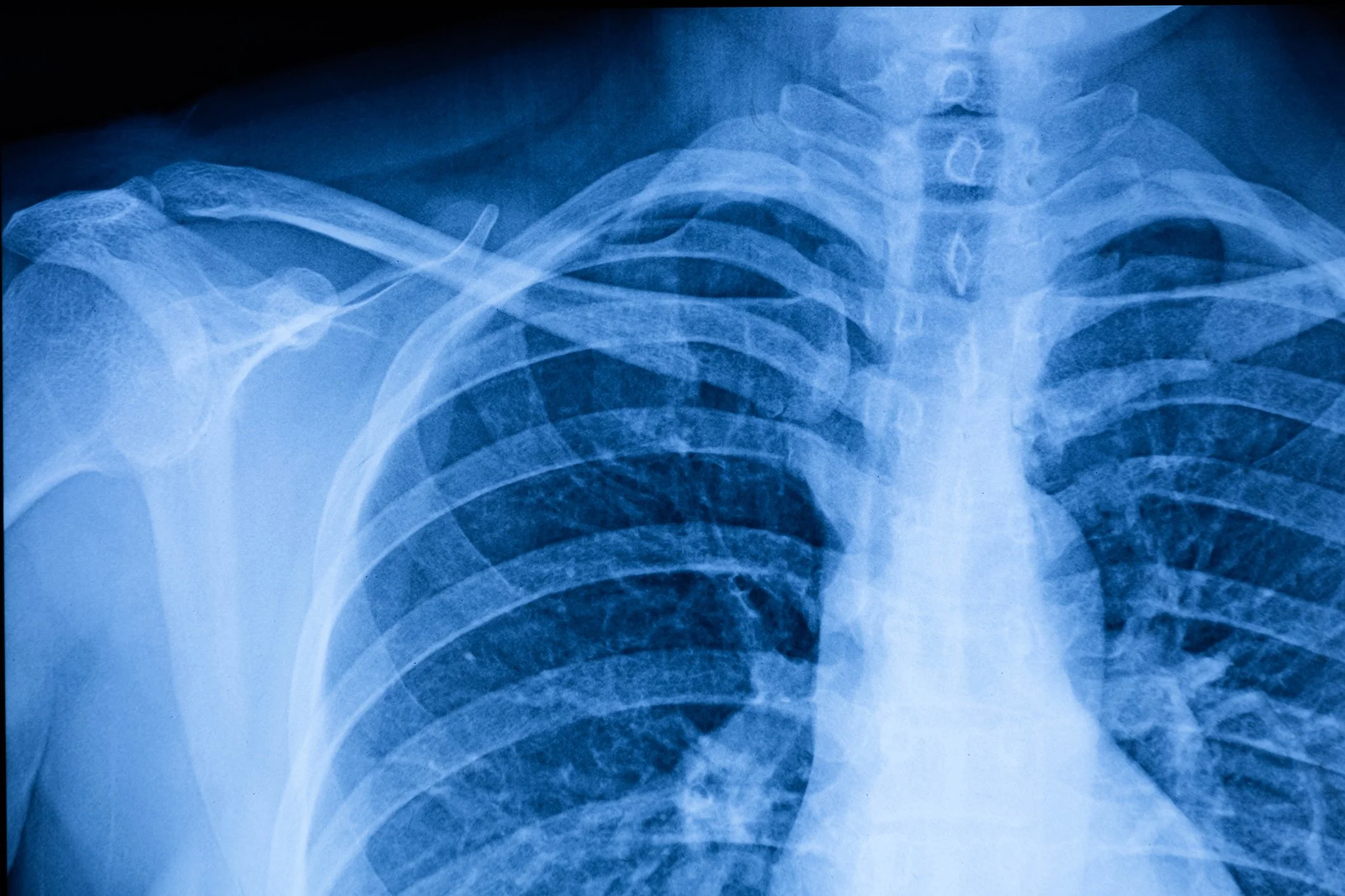 X-ray image of a human chest showing the ribs, spine, and shoulder bones in a blue hue.