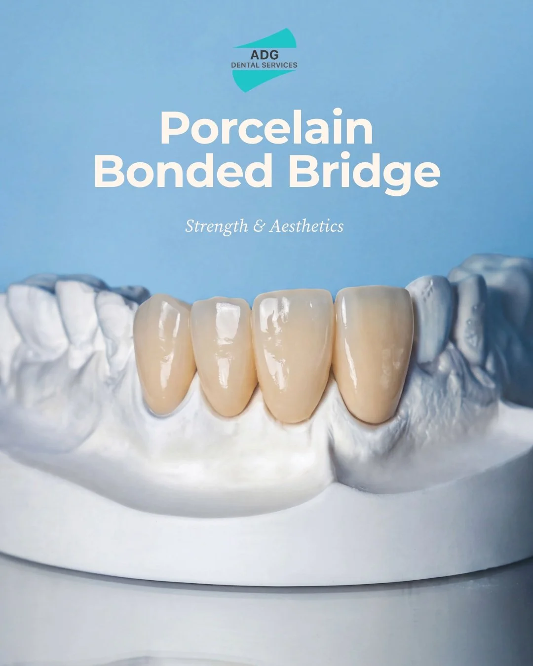 Dentists, we know how much a well-fitting restoration matters.

When your diary is full and you&rsquo;re working through complex restorative cases, the last thing you need is uncertainty at the fit appointment.

This porcelain-bonded bridge recently 
