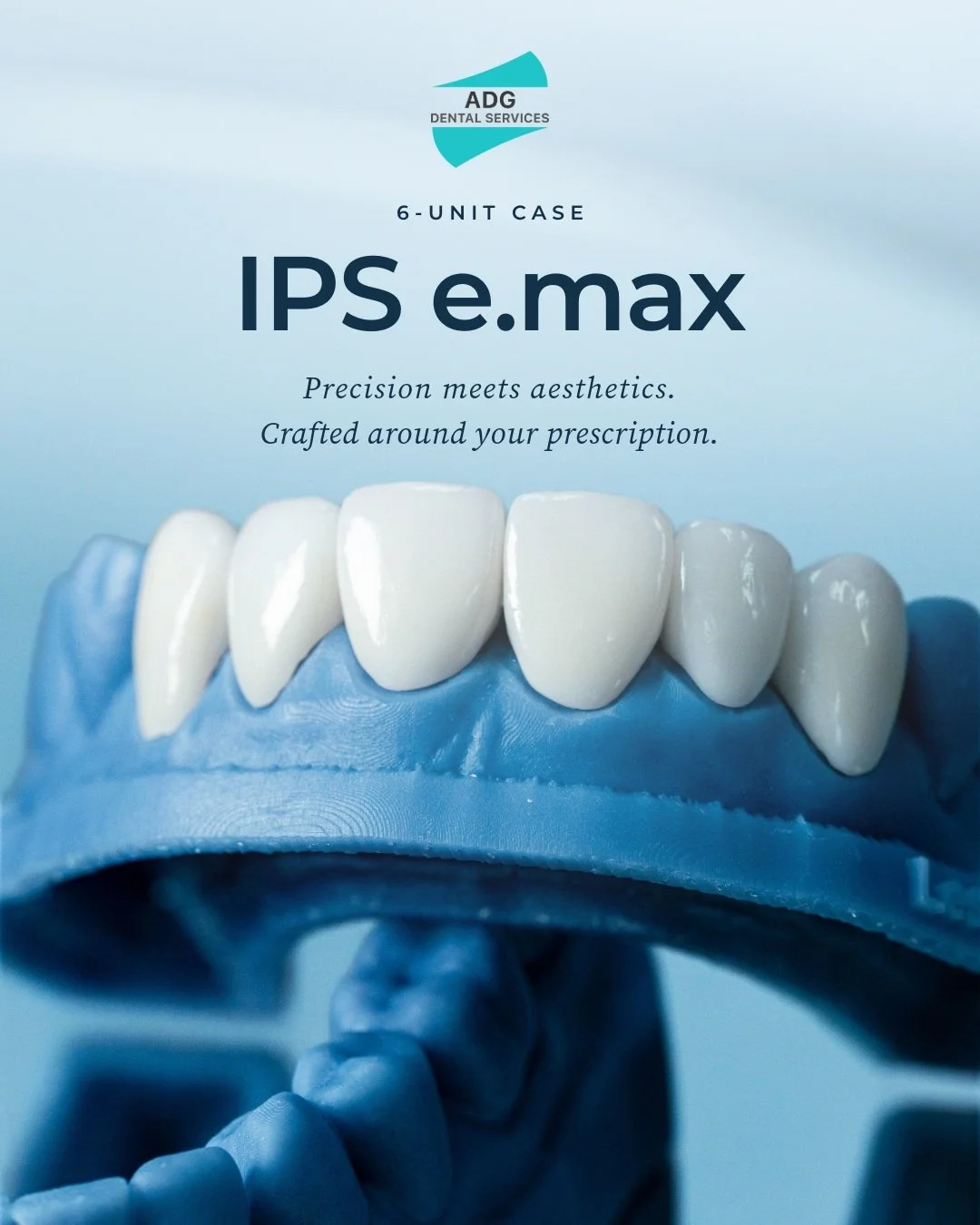 Great restorative work takes teamwork.

For this six-unit E.max veneers case, careful attention to shade, shape and detail helps ensure each restoration works in harmony with the overall treatment plan.

We work closely with our dentist clients to un