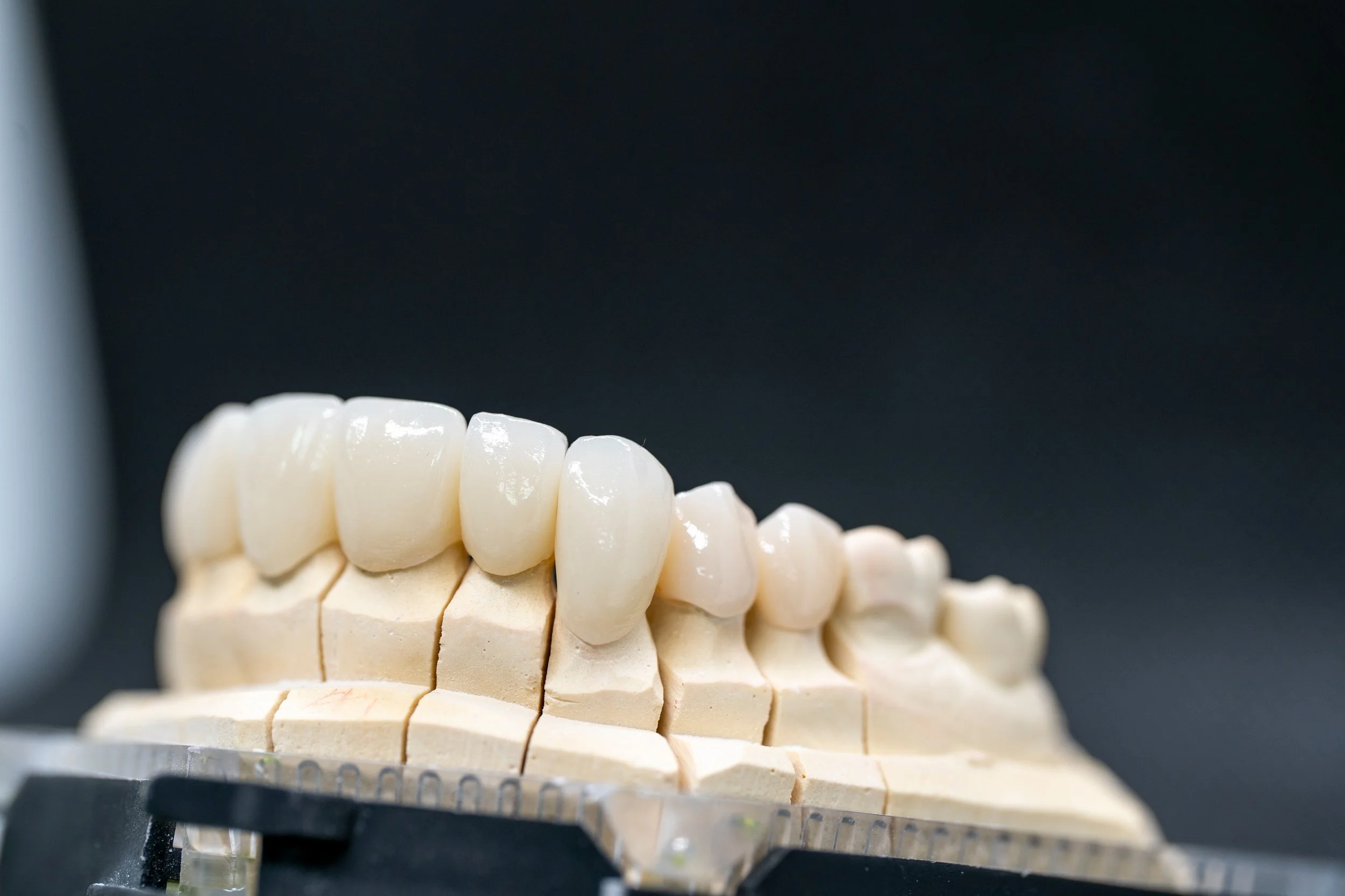 10-UNIT E.MAX CASE

A recent 10-unit E.max case completed by the ADG Dental Services team.

Before moving into production, we completed a digital wax-up, working closely with our dentist to plan the proposed result and make sure we were all working t