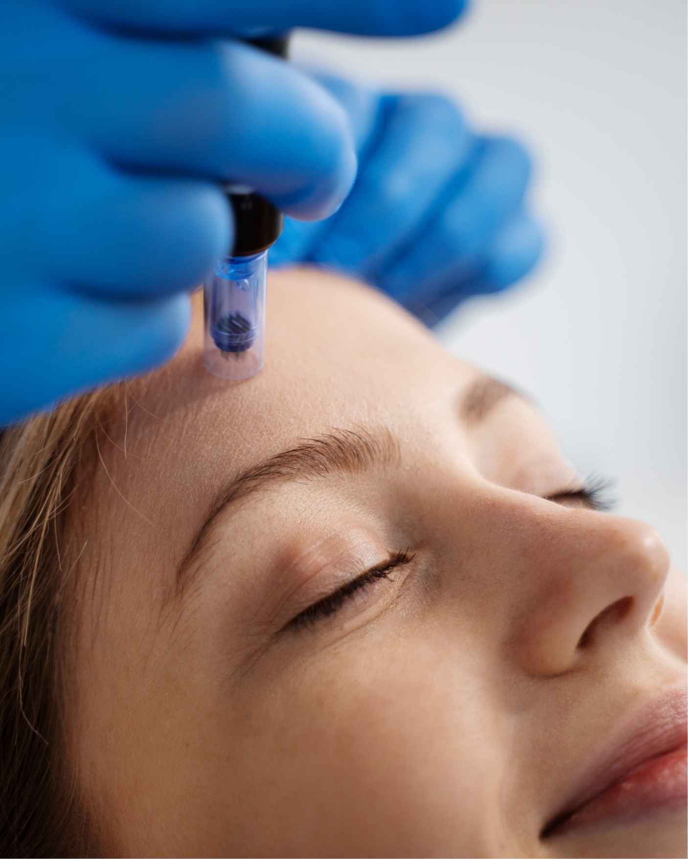 Medspa in Sherman Oaks, CA 91403 l Microneedling Near Me