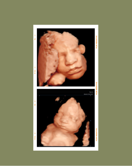 A 3D ultrasound image of a developing fetus in the womb.