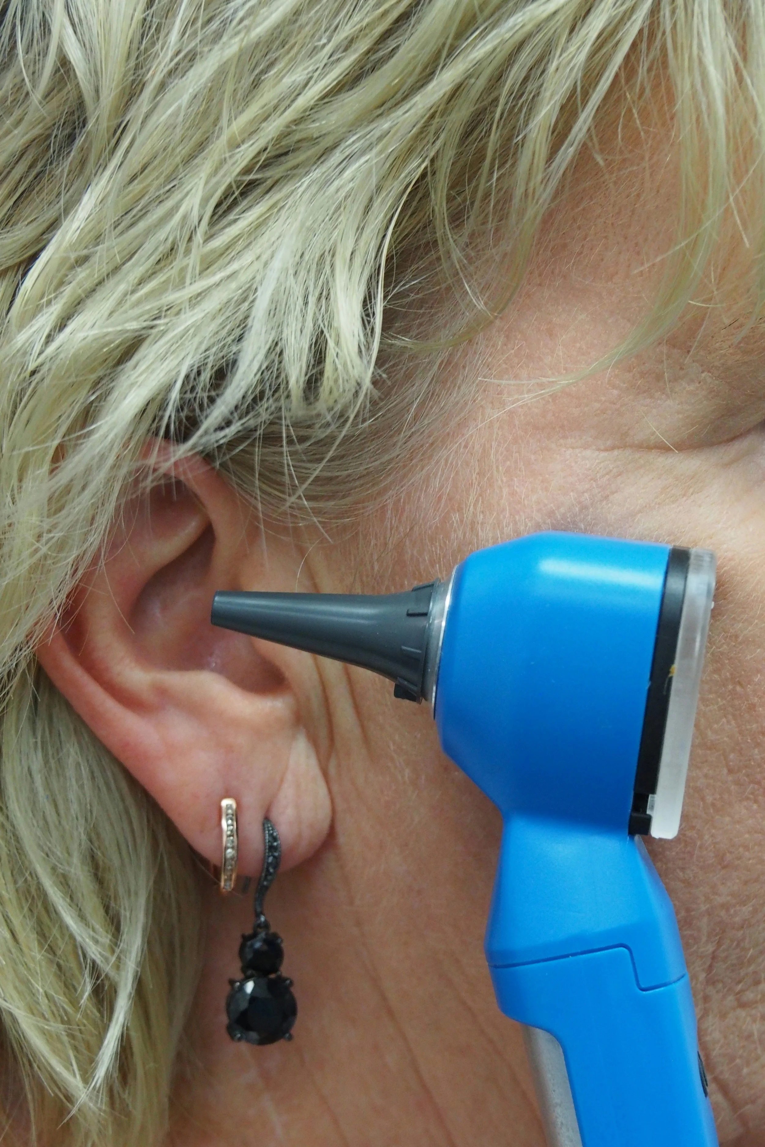 Close-up of a person with blonde hair receiving a medical or cosmetic treatment with a blue handheld device near their ear and temple.