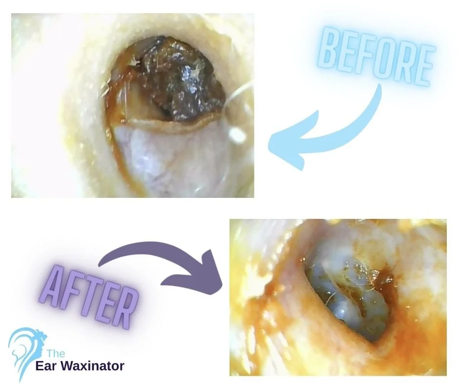 Comparison of an ear before and after cleaning, showing wax removal with a tool.