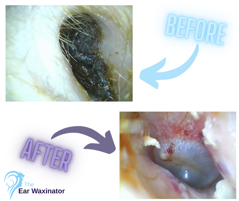 Close-up comparison of an ear before and after ear cleaning with ear wax removal product from The Ear Waxinator.