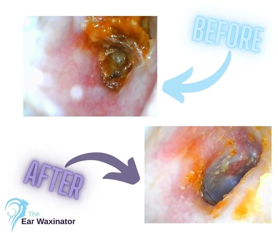 Close-up images of an ear canal before and after earwax removal. The first image shows a blocked ear canal with dense wax; the second image shows the ear canal after removal, with less wax and clearer passage.