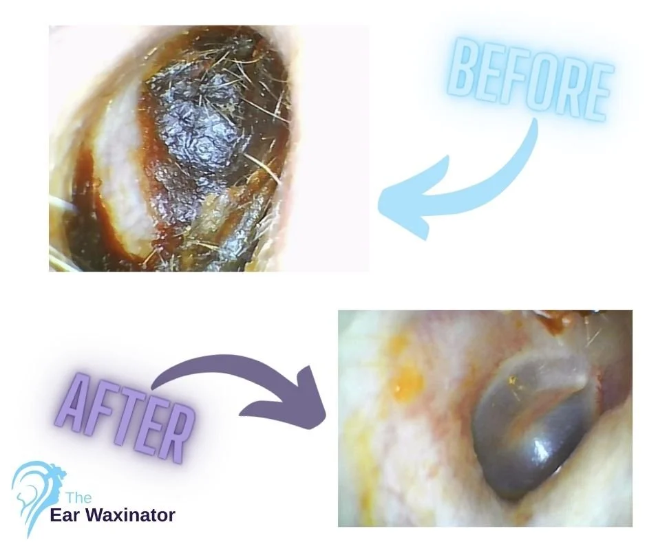 Close-up of an ear canal before and after cleaning with ear wax removal product, showing the removal of earwax.