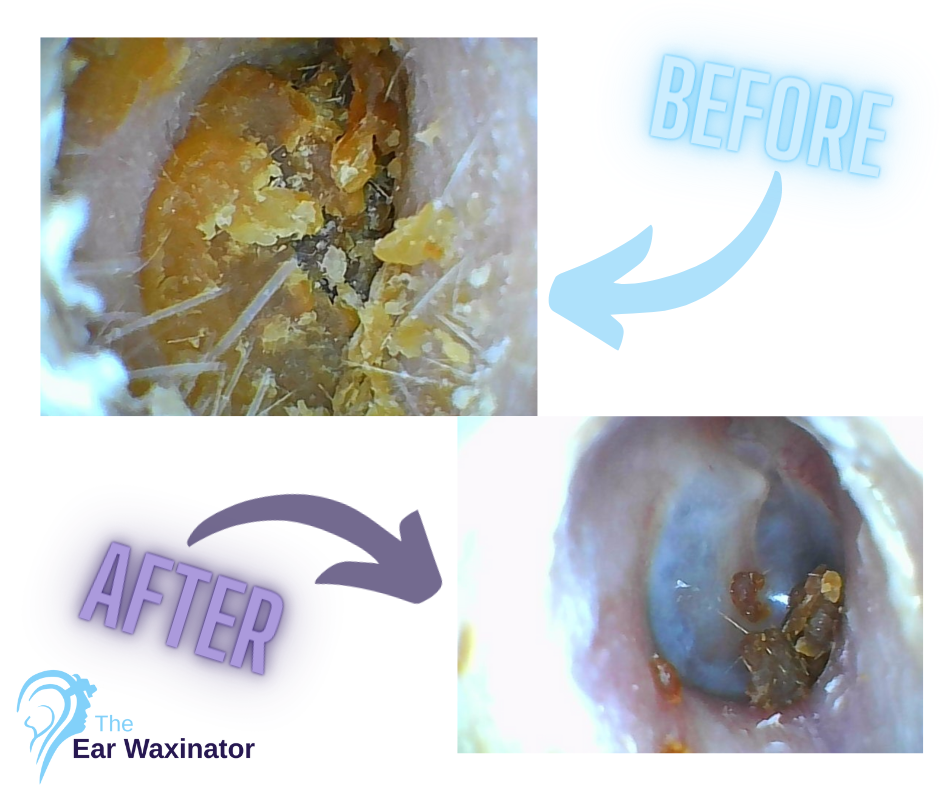 Comparison of an ear canal before and after earwax removal, with visible earwax buildup in the 'before' image and cleaner canal in the 'after' image, branded with 'The Ear Waxinator' logo.