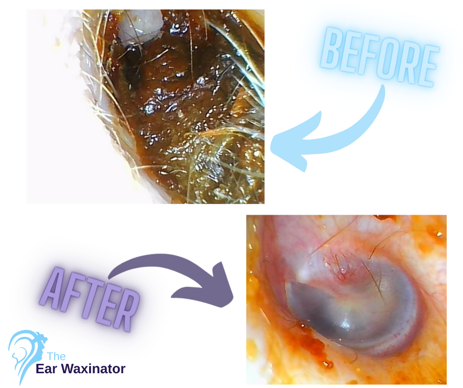 Comparison of ear drum before and after ear wax removal, showing a clear ear drum after cleaning by The Ear Waxinator.
