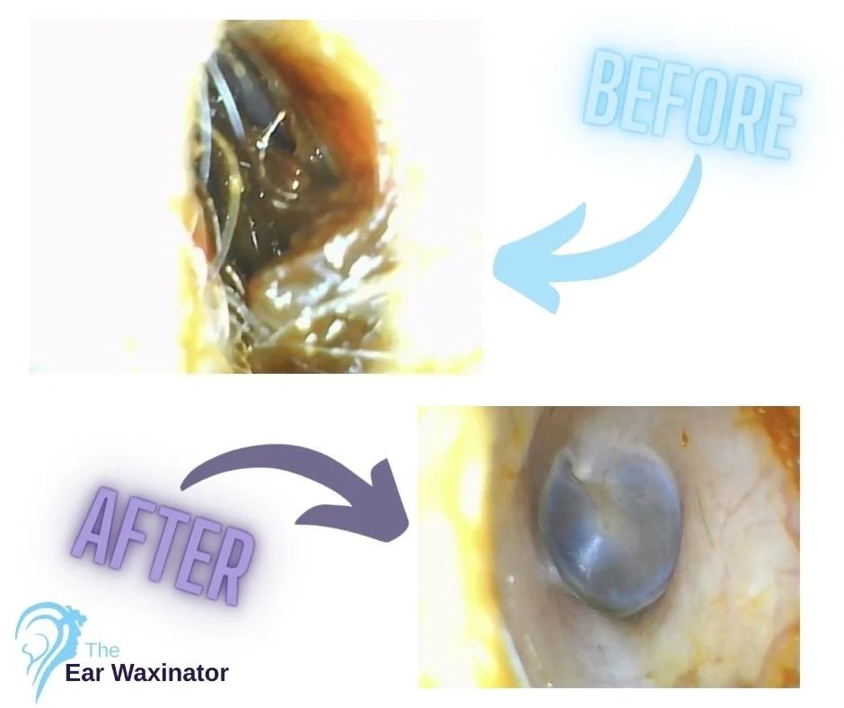 Comparison of ear cleaning before and after using The Ear Waxinator, showing removal of earwax and debris.