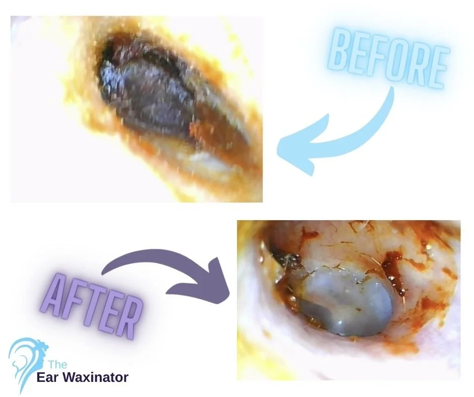 Comparison of an ear canal before and after ear wax removal, showing significant removal of ear wax in the after image.