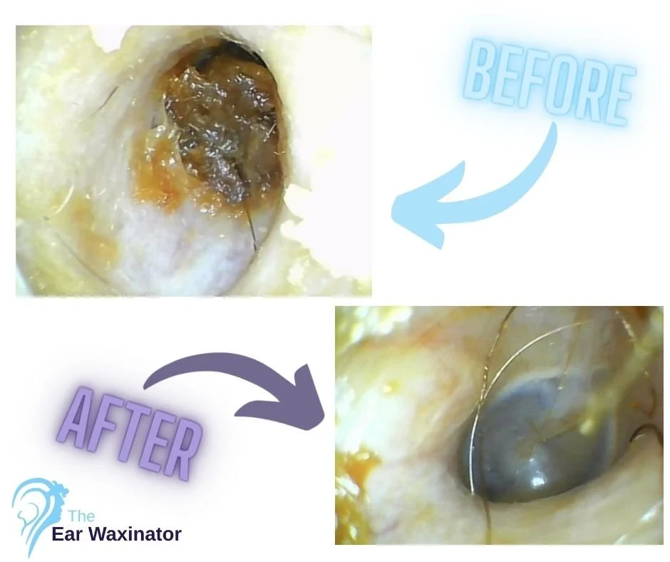 Close-up of an ear canal showing the removal of earwax before and after cleaning with Ear Waxinator