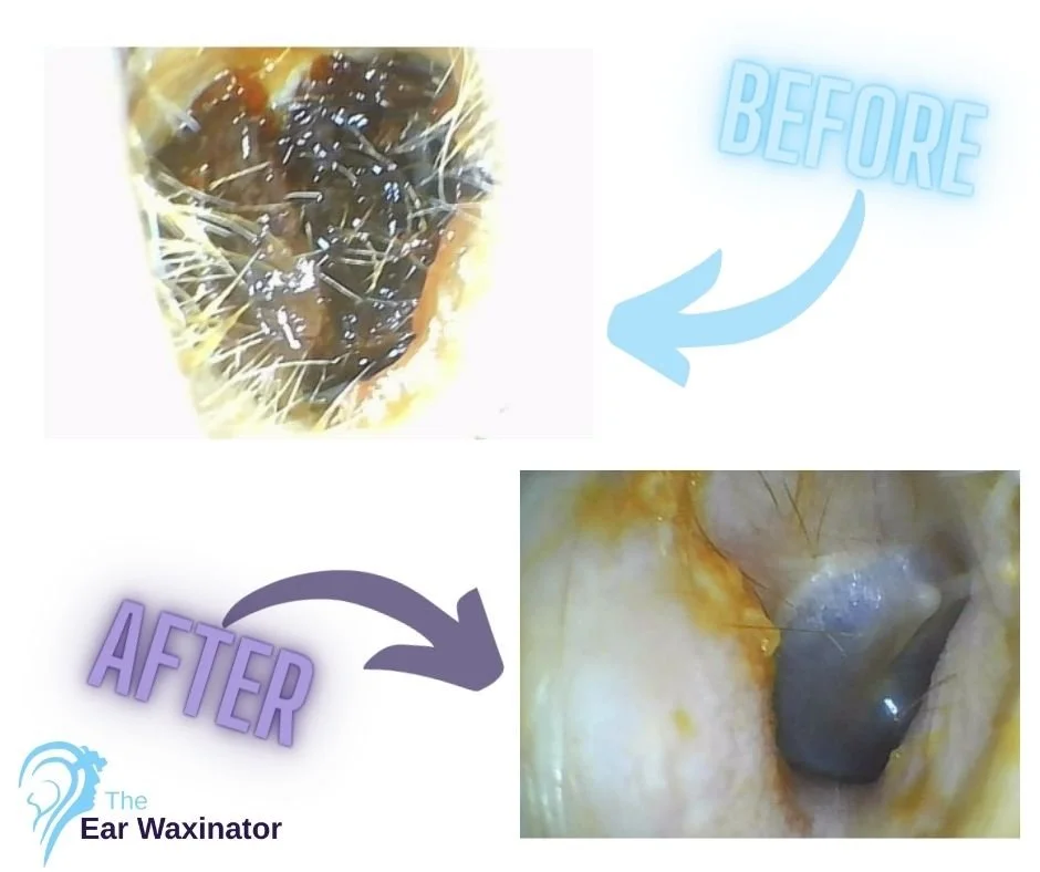Comparison image showing an ear before and after treatment with The Ear Waxinator, with the ear wax removal process depicted in the "after" image.