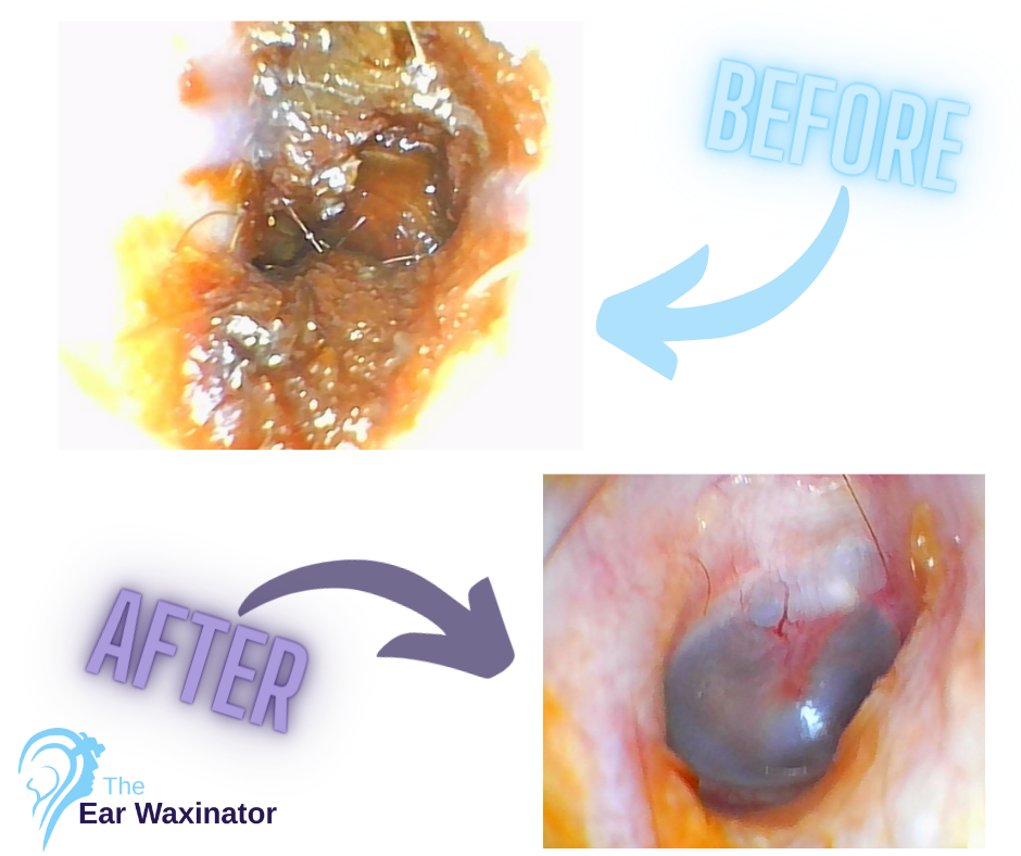 Comparison of an ear canal before and after earwax removal showing significant reduction in wax buildup.