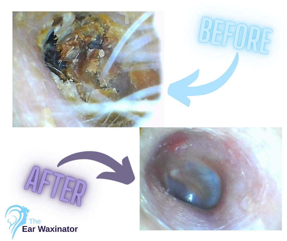 Comparison of an ear canal before and after earwax removal using The Ear Waxinator. The 'before' image shows clogged ear with a large amount of earwax, and the 'after' image shows a clean, clear ear canal.