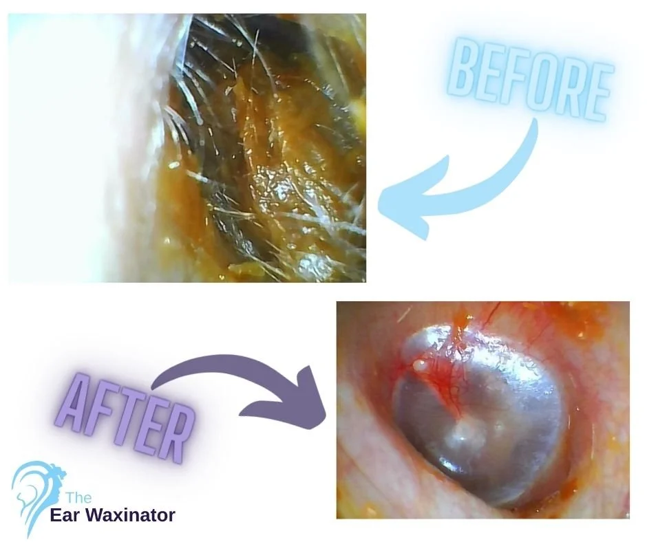 Close-up images showing an ear before and after earwax removal with a wax optimizer. The 'before' image depicts a dirty ear canal filled with earwax, while the 'after' image shows a clean ear canal with clear visibility.