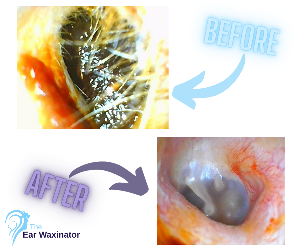 Comparison of ear canal before and after ear wax removal. The 'before' image shows a clogged ear canal with thick earwax, while the 'after' image shows a clean Ear canal after using the ear waxator.