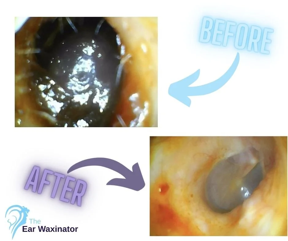 Comparison of an ear canal before and after using ear wax remover. The before image shows a blocked ear canal with impacted wax, and the after image shows a cleaned ear canal with the wax removed.