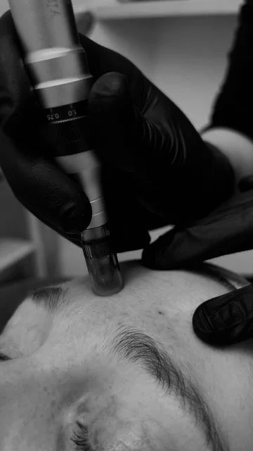 MicroNeedling