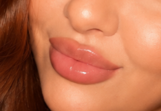 Lip Filler