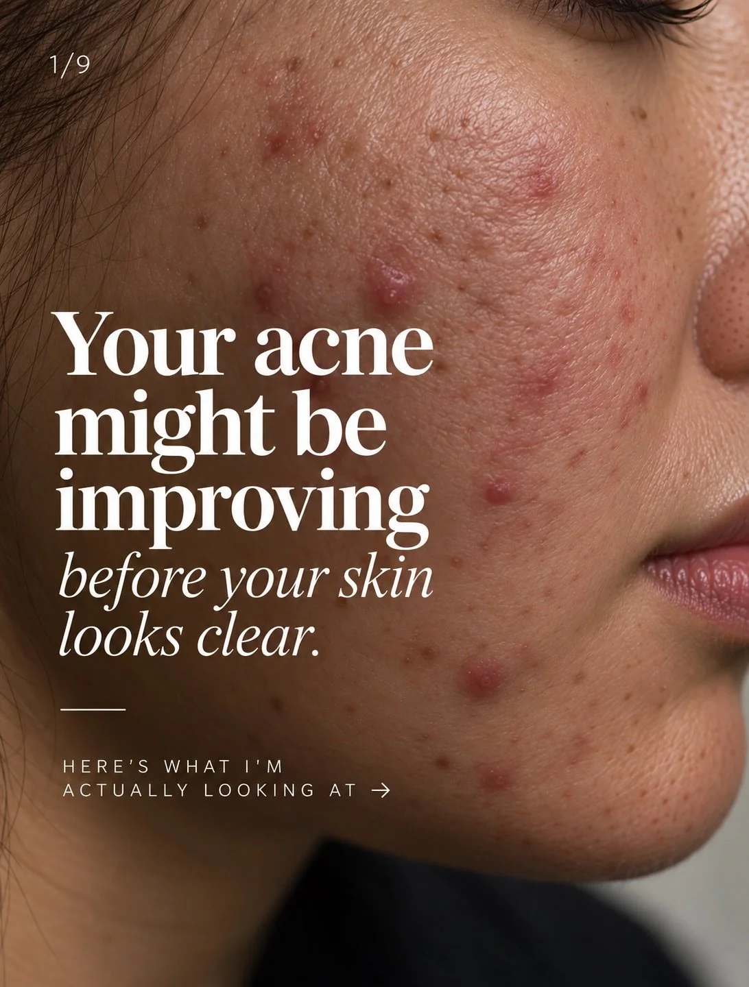 Acne progress can be so easy to miss when you&rsquo;re looking at your skin every single day. 🤍 
Here are a few things I look for while treating my acne clients.

📍WOODLAND HILLS