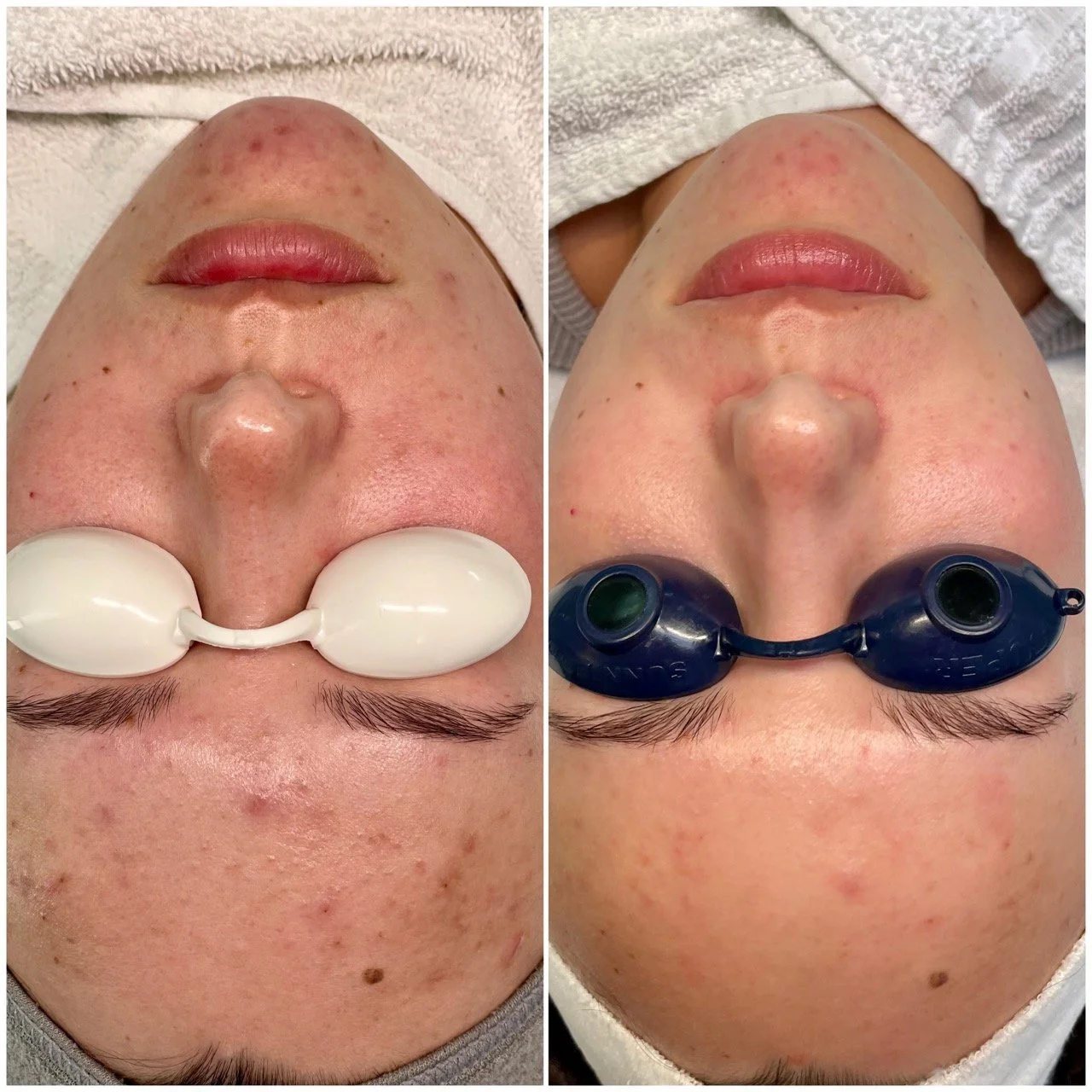 Before and after images of a person receiving a facial treatment, showing improved skin texture and reduced redness.
