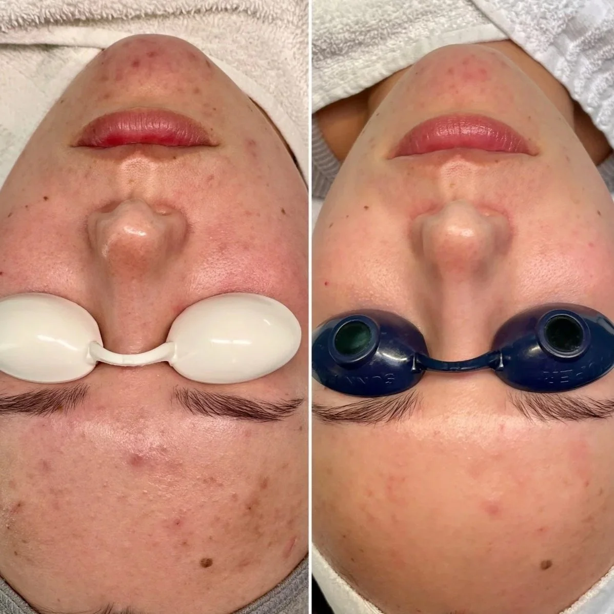 Comparison of a person's face before and after a skincare treatment, showing reduced redness and clearer skin, lying down with eyes closed, using binocular-like eye masks.