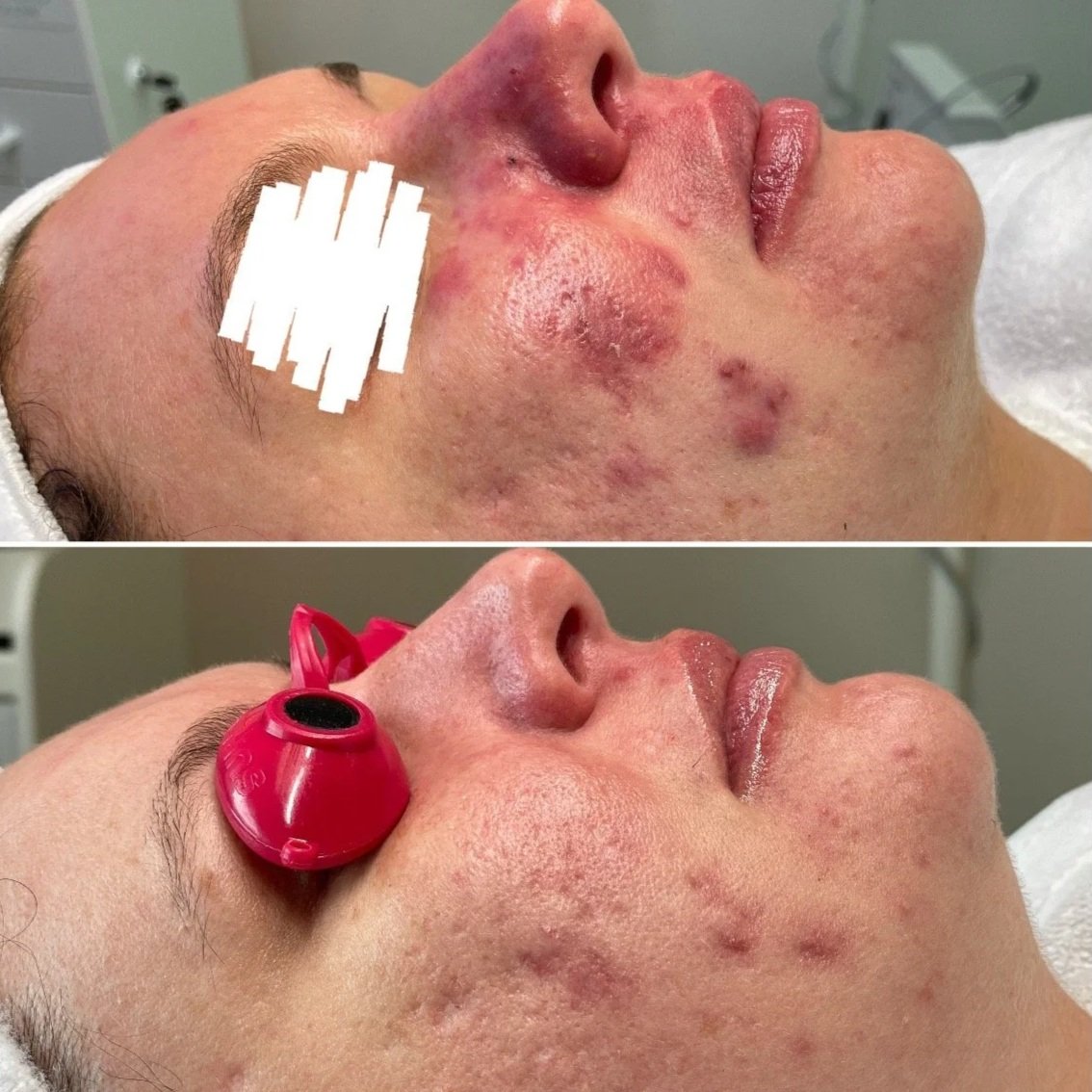 Before and after close-up photos of facial treatment showing improvement in acne and skin condition.
