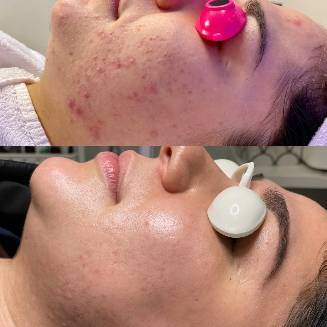 Before and after images of a woman's face, with noticeable skin improvement after a skincare treatment, including reduction of acne and redness.