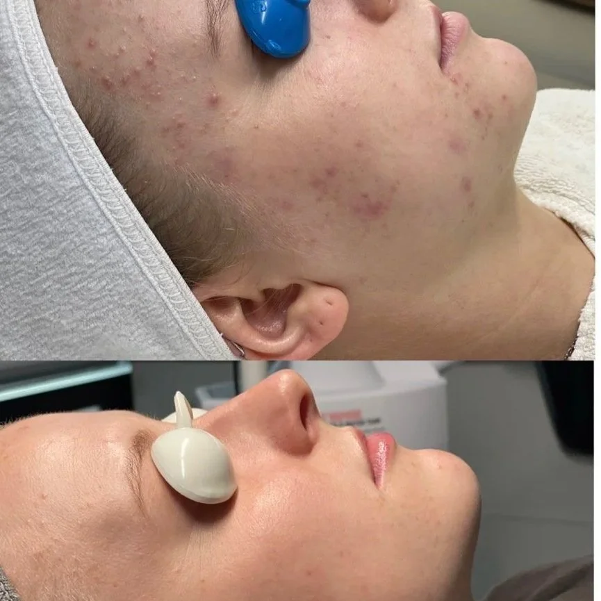 Side-by-side comparison of a woman's face before and after a dermatological treatment. In the top image, her skin shows acne and redness; in the bottom image, her skin appears clearer and smoother, with a professional device placed near her eye.