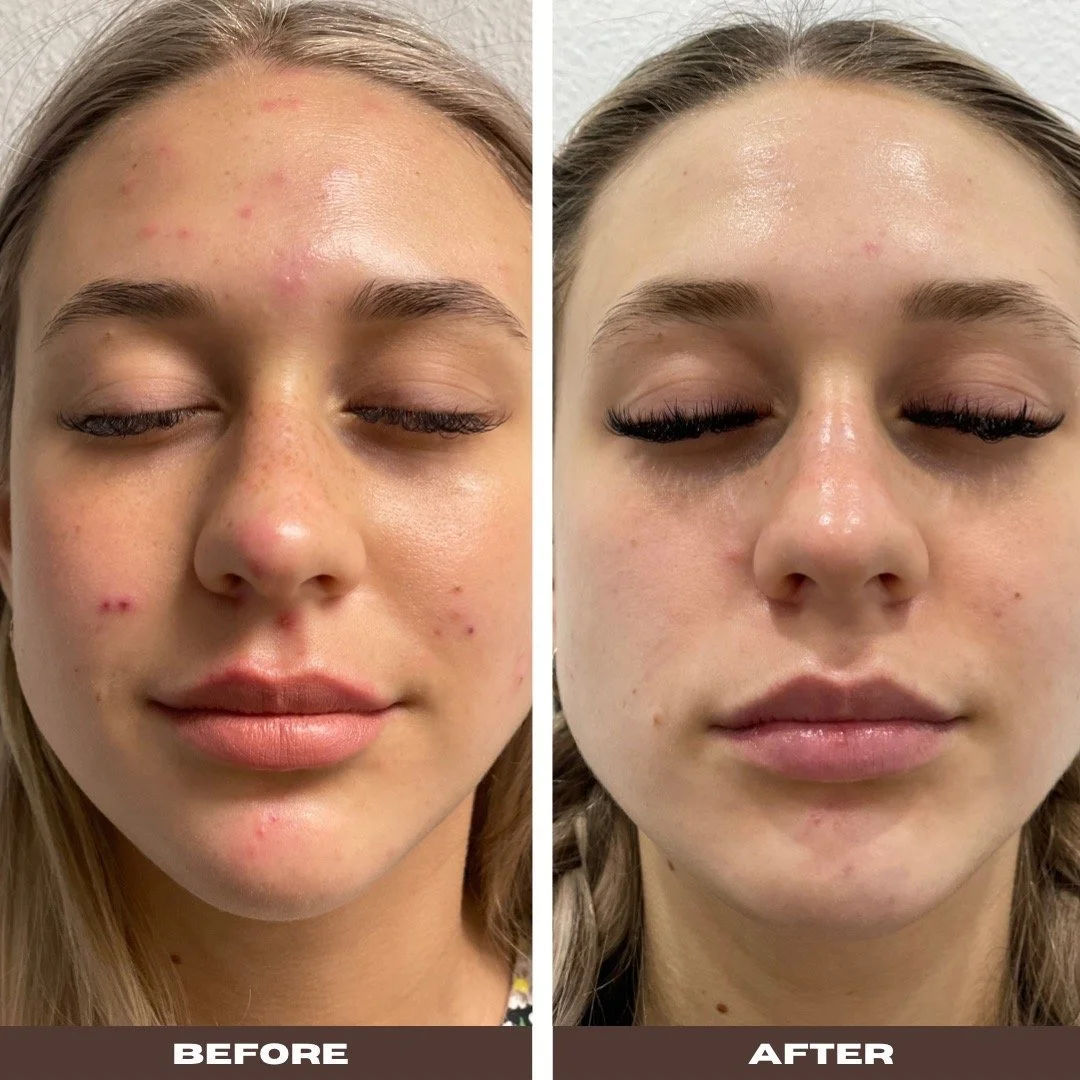 Side-by-side close-up of a woman's face showing improvement in skin condition, with acne and blemishes before and clearer skin after treatment or skincare routine.