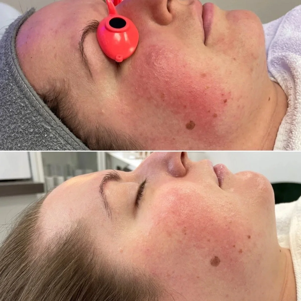 A side-by-side comparison of a woman's face before and after a facial treatment. The before image shows her with redness, blemishes, and a mole on her cheek. The after image shows her skin looking clearer, smoother, and more even-toned.