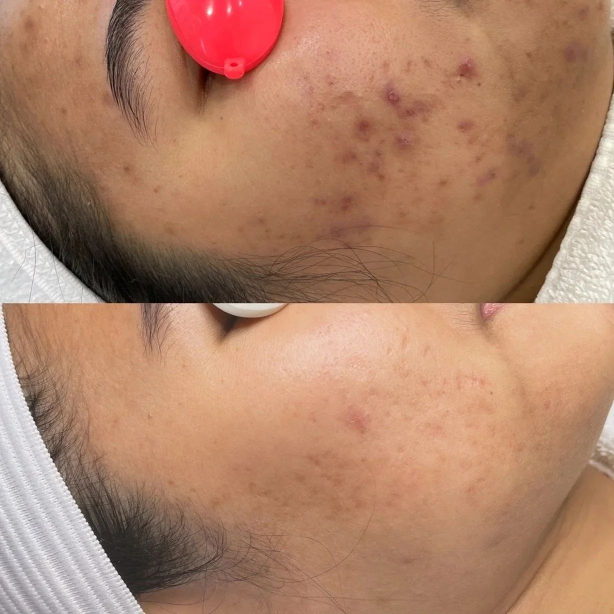 Close-up of a person's cheek showing skin before and after acne treatment, with visible reduction in acne blemishes and scarring.