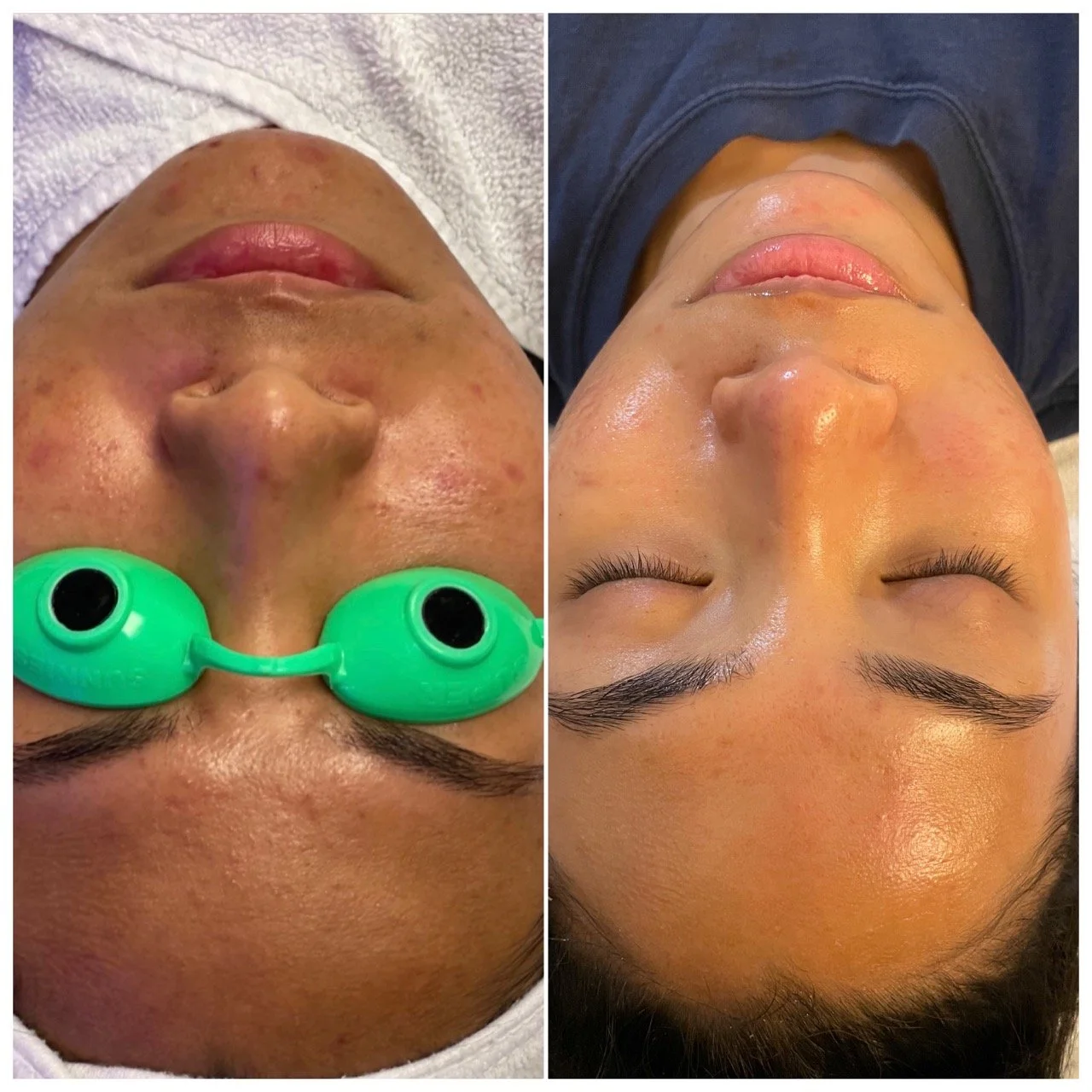 Side-by-side comparison of a woman's face before and after a skincare treatment, showing improved skin clarity and texture.