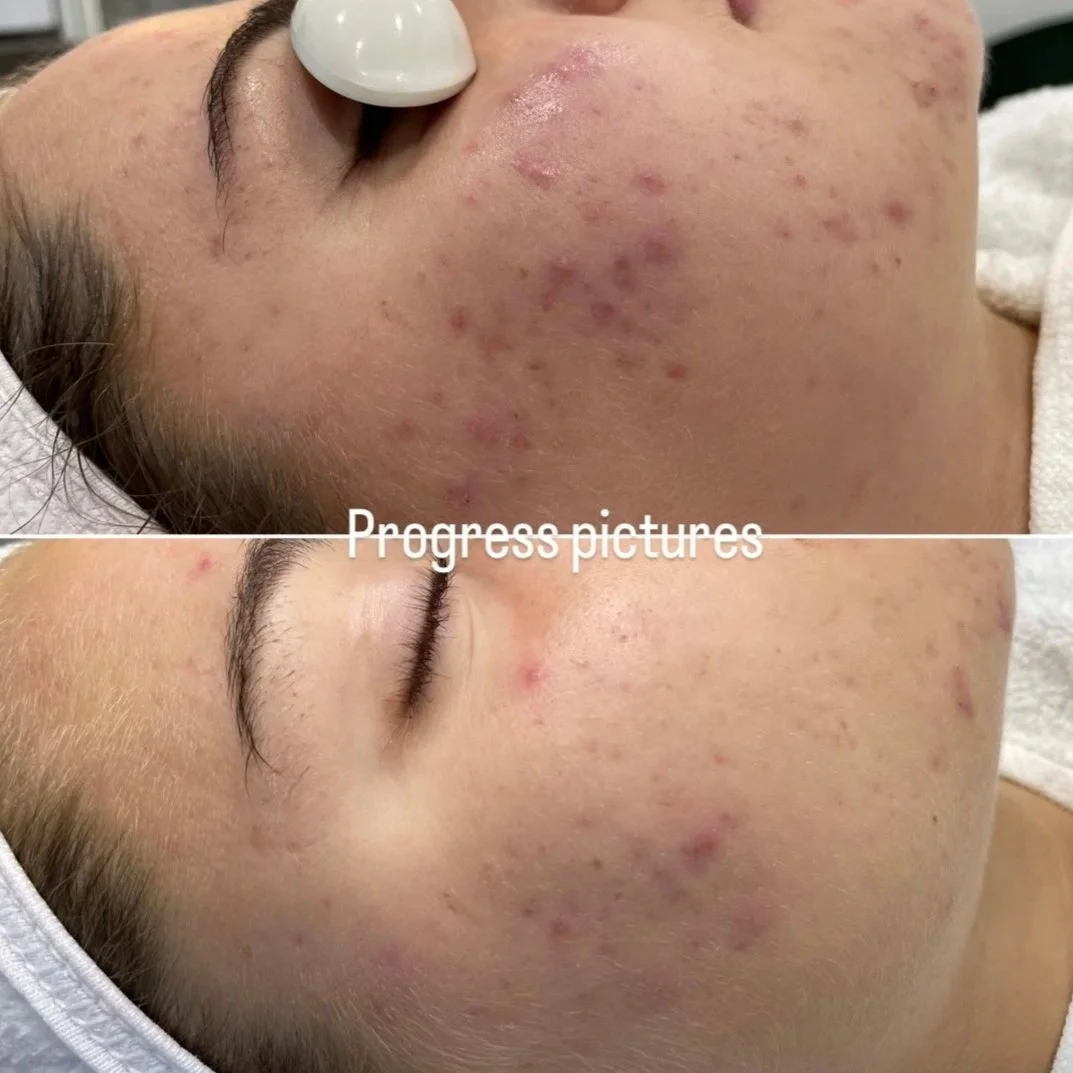 Side-by-side comparison of a woman's face showing improvement in skin clarity and reduction of acne scars, with the top image displaying more blemishes and the bottom image showing clearer skin.